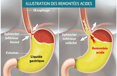 Remontée Acide